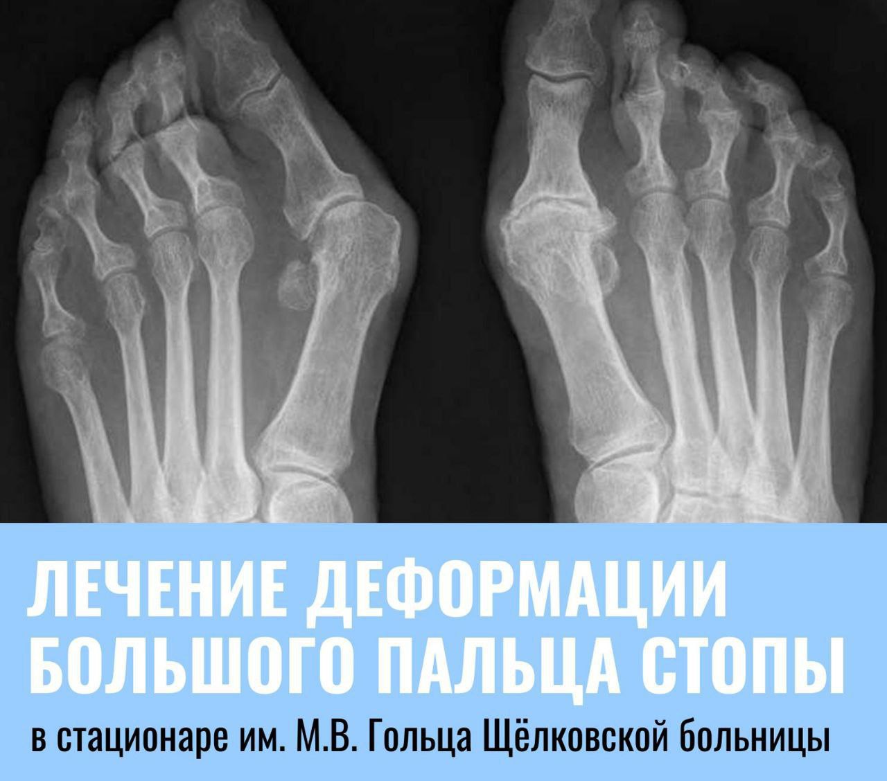 Жители Фрязино, Щёлково и Лосино-Петровского могут исправить косточку на ноге в стационаре Щёлковской больницы