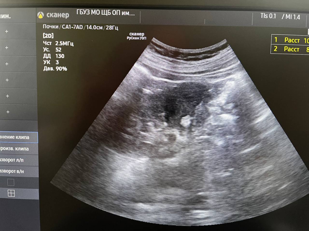 В прошедшую субботу в г. Фрязино в рамках дня открытых дверей, посвящённому здоровым почкам, пришли обследоваться 22 человека